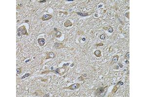 Immunohistochemistry of paraffin-embedded Human brain cancer using WIPI1 Polyclonal Antibody at dilution of 1:100 (40x lens). (WIPI1 antibody)