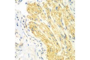 Immunohistochemistry of paraffin-embedded human gastric cancer using PTK6 antibody. (PTK6 antibody  (AA 222-451))