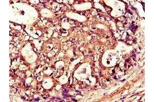 Immunohistochemistry of paraffin-embedded human gastric cancer using ABIN7173790 at dilution of 1:100 (RANKL antibody  (AA 73-306))
