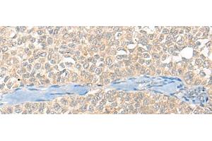 Immunohistochemistry of paraffin-embedded Human ovarian cancer tissue using SNX6 Polyclonal Antibody at dilution of 1:40(x200) (SNX6 antibody)