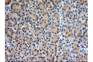 Immunohistochemical staining of paraffin-embedded Adenocarcinoma of Human ovary tissue using anti-PDE4A mouse monoclonal antibody. (PDE4A antibody)