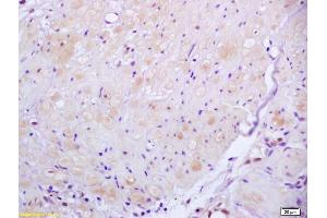 Formalin-fixed and paraffin embedded human gastric carcinoma labeled with Anti ROCK2 Polyclonal Antibody, Unconjugated (ABIN673359) at 1:200 followed by conjugation to the secondary antibody and DAB staining