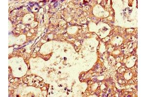 Immunohistochemistry of paraffin-embedded human gastric cancer using ABIN7144511 at dilution of 1:100 (AQP3 antibody  (AA 210-244))