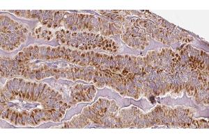 ABIN6273336 at 1/100 staining Human thyroid cancer tissue by IHC-P. (TSH receptor antibody  (Internal Region))