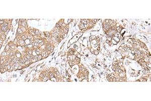 Immunohistochemistry of paraffin-embedded Human gastric cancer tissue using TEAD2 Polyclonal Antibody at dilution of 1:60(x200) (TEAD2 antibody)