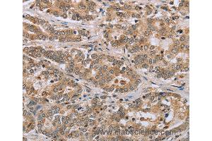 Immunohistochemistry of Human liver cancer using CLEC16A Polyclonal Antibody at dilution of 1:45