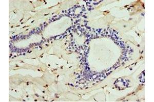 Immunohistochemistry of paraffin-embedded human breast cancer using ABIN7147563 at dilution of 1:100 (ALG1 antibody  (AA 215-464))