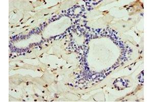 Immunohistochemistry of paraffin-embedded human breast cancer using ABIN7147563 at dilution of 1:100