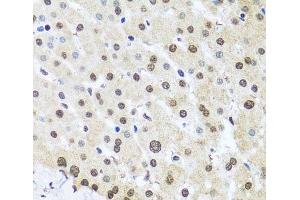 Immunohistochemistry of paraffin-embedded Human liver damage using FUBP1 Polyclonal Antibody at dilution of 1:100 (40x lens). (FUBP1 antibody)