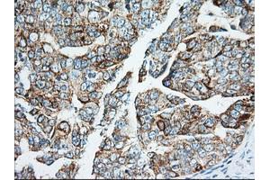 Immunohistochemical staining of paraffin-embedded Adenocarcinoma of Human breast tissue using anti-IGF2BP2 mouse monoclonal antibody.