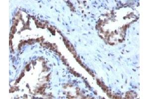 Formalin-fixed, paraffin-embedded human prostate carcinoma stained with Cyclin B1 antibody. (Cyclin B1 antibody)
