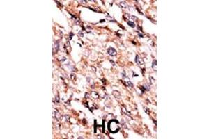 Formalin-fixed and paraffin-embedded human cancer tissue reacted with the primary antibody, which was peroxidase-conjugated to the secondary antibody, followed by AEC staining.