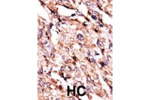 Formalin-fixed and paraffin-embedded human cancer tissue reacted with the primary antibody, which was peroxidase-conjugated to the secondary antibody, followed by AEC staining. (BCKDK antibody  (AA 120-151))