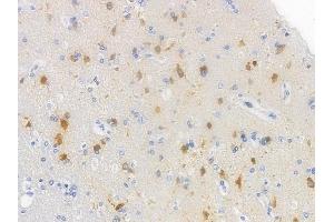 ABIN6254999 and ABIN6267500 at 1/100 staining human glioblastoma by IHC-P.