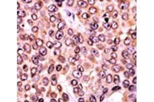 IHC analysis of FFPE human breast carcinoma tissue stained with the p-p21 antibody.