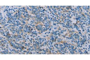 Immunohistochemistry of paraffin-embedded Human breast cancer using Claudin 4 Polyclonal Antibody at dilution of 1:35 (Claudin 4 antibody)
