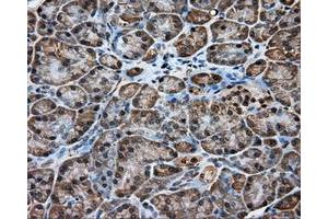 Immunohistochemical staining of paraffin-embedded Adenocarcinoma of ovary tissue using anti-RC200180 mouse monoclonal antibody. (KCTD5 antibody)