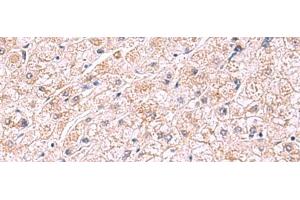 Immunohistochemistry of paraffin-embedded Human liver cancer tissue using PDRG1 Polyclonal Antibody at dilution of 1:75(x200)