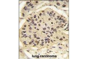 Formalin-fixed and paraffin-embedded human lung carcinoma tissue reacted with SOX2 Antibody (ABIN387798 and ABIN2843854) , which was peroxidase-conjugated to the secondary antibody, followed by DAB staining. (SOX2 antibody)