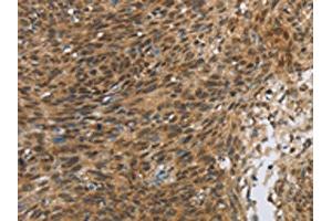 The image on the left is immunohistochemistry of paraffin-embedded Human cervical cancer tissue using ABIN7190675(FOXB1 Antibody) at dilution 1/30, on the right is treated with synthetic peptide. (FOXB1 antibody)