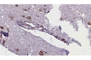 ABIN6276388 at 1/100 staining Human brain cancer tissue by IHC-P. (ACVR1C/ALK7 antibody  (C-Term))