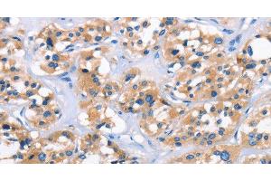 Immunohistochemistry of paraffin-embedded Human thyroid cancer tissue using APOL6 Polyclonal Antibody at dilution 1:50 (APOL6 antibody)