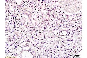 Formalin-fixed and paraffin embedded human gastric carcinoma labeled with Anti CHMP1A Polyclonal Antibody, Unconjugated (ABIN705236) at 1:200 followed by conjugation to the secondary antibody and DAB staining (CHMP1A antibody  (AA 51-150))