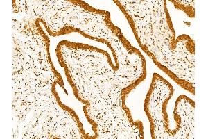 ABIN7094791 and ABIN7098842 at 1/100 staining Human kidney cancer by IHC-P. (UBA1 antibody  (Internal Region))
