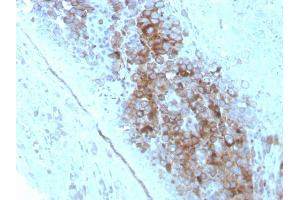 Formalin-fixed, paraffin-embedded human Melanoma stained with CD63 Mouse Monoclonal Antibody (LAMP3/2789). (CD63 antibody  (AA 100-197))