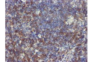Immunohistochemical staining of paraffin-embedded Human lymphoma tissue using anti-NMT2 mouse monoclonal antibody. (NMT2 antibody)