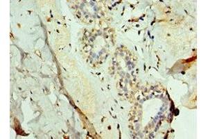 Immunohistochemistry of paraffin-embedded human breast cancer using ABIN7143736 at dilution of 1:100 (FUT6 antibody  (AA 170-359))