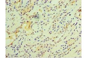Immunohistochemistry of paraffin-embedded human breast cancer using ABIN7153127 at dilution of 1:100 (FOSL2 antibody  (AA 187-326))