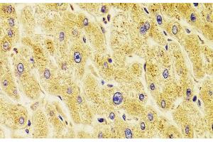 Immunohistochemistry of paraffin-embedded Human liver damage using TXNL1 Polyclonal Antibody at dilution of 1:100 (40x lens).