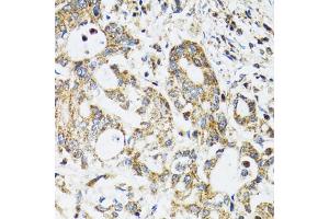 Immunohistochemistry of paraffin-embedded human colon carcinoma using EPB41 antibody (ABIN1872554) at dilution of 1:100 (40x lens). (EPB41 antibody)