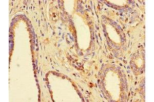 Immunohistochemistry of paraffin-embedded human prostate cancer using ABIN7160076 at dilution of 1:100 (BUB3 antibody  (AA 6-217))