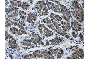 Immunohistochemical staining of paraffin-embedded Carcinoma of liver tissue using anti-AKR1A1mouse monoclonal antibody. (AKR1A1 antibody)