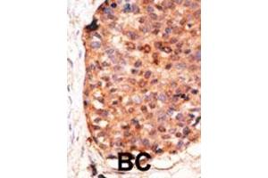 Formalin-fixed and paraffin-embedded human cancer tissue reacted with the primary antibody, which was peroxidase-conjugated to the secondary antibody, followed by DAB staining. (APOBEC3G antibody  (C-Term))