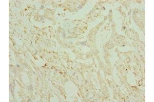 Immunohistochemistry of paraffin-embedded human pancreatic cancer using ABIN7149016 at dilution of 1:100 (CDO1 antibody  (AA 1-200))