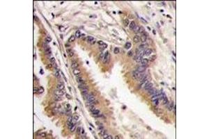 Formalin-fixed and paraffin-embedded human lung carcinoma tissue reacted with ERK4 antibody (C-term), which was peroxidase-conjugated to the secondary antibody, followed by DAB staining. (MAPK4 antibody  (C-Term))