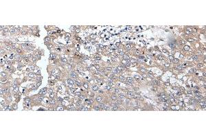 Immunohistochemistry of paraffin-embedded Human liver cancer tissue using BRMS1L Polyclonal Antibody at dilution of 1:45(x200) (BRMS1L antibody)