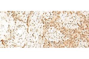 Immunohistochemistry of paraffin-embedded Human ovarian cancer tissue using HIST1H1D Polyclonal Antibody at dilution of 1:55(x200) (Histone H1.3 antibody)