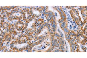 Immunohistochemistry of paraffin-embedded Human thyroid cancer tissue using BST1 Polyclonal Antibody at dilution 1:50 (BST1 antibody)