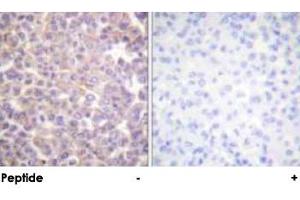 Immunohistochemical analysis of paraffin-embedded human breast carcinoma tissue using ERBB3 polyclonal antibody . (ERBB3 antibody)