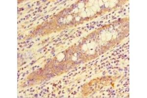 Immunohistochemistry of paraffin-embedded human colon cancer using ABIN7155348 at dilution of 1:100 (HIST1H1C antibody  (AA 2-213))