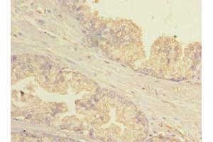 Immunohistochemistry of paraffin-embedded human prostate cancer using ABIN7154781 at dilution of 1:100 (GBP5 antibody  (AA 321-500))
