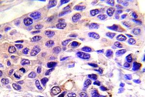 Immunohistochemistry (IHC) analyzes of p-GSK3alpha antibody in paraffin-embedded human breast carcinoma tissue. (GSK3 alpha antibody  (pSer21))