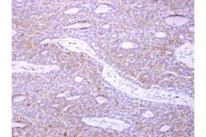 IHC-P Image p41-ARCb antibody [N1], N-term detects p41-ARCb protein at cytosol on human lung carcinoma by immunohistochemical analysis. (ARPC1B antibody  (N-Term))