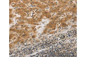 Immunohistochemistry of Human liver cancer using PIBF1 Polyclonal Antibody at dilution of 1:20