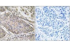 Immunohistochemistry analysis of paraffin-embedded human lung carcinoma, using PLA2G4E Antibody. (PLA2G4E antibody  (AA 401-450))
