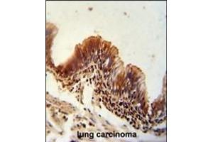 TXNDC6 antibody (Center) (ABIN654968 and ABIN2844606) immunohistochemistry analysis in formalin fixed and paraffin embedded human lung carcinoma followed by peroxidase conjugation of the secondary antibody and DAB staining. (NME9 antibody  (AA 111-139))